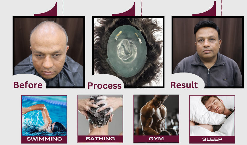 Men’s Thick Patch, Polyfuse Patch for Men, Thick Hair Patch for Men, Men’s Polyfuse Hair Patch, Natural-Look Hair Patch, Durable Hair Patch for Men, Men’s Hair Replacement Patch, Realistic Polyfuse Hair Patch, Best Polyfuse Patch for Men, Men’s Hair System Patch, Non-Surgical Hair Patch