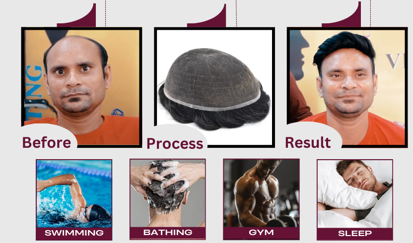 Men’s Thick Patch, Polyfuse Patch for Men, Thick Hair Patch for Men, Men’s Polyfuse Hair Patch, Natural-Look Hair Patch, Durable Hair Patch for Men, Men’s Hair Replacement Patch, Realistic Polyfuse Hair Patch, Best Polyfuse Patch for Men, Men’s Hair System Patch, Non-Surgical Hair Patch