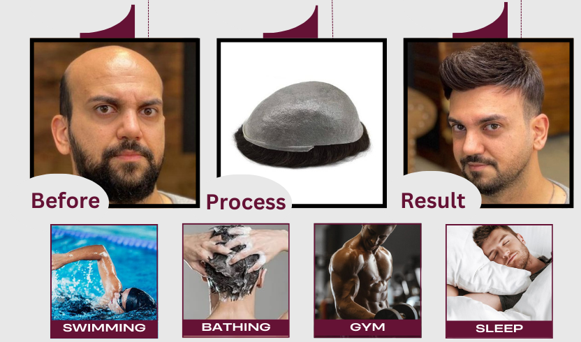 Men’s Thick Patch, Polyfuse Patch for Men, Thick Hair Patch for Men, Men’s Polyfuse Hair Patch, Natural-Look Hair Patch, Durable Hair Patch for Men, Men’s Hair Replacement Patch, Realistic Polyfuse Hair Patch, Best Polyfuse Patch for Men, Men’s Hair System Patch, Non-Surgical Hair Patch